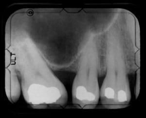 the-truth-about-mercury-fillings