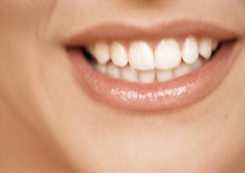 at-home whitening