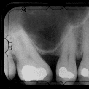 Celiac Disease and Cavities