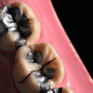 Are Mercury Fillings Safe