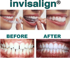 Save $1,000 on Invisalign This December