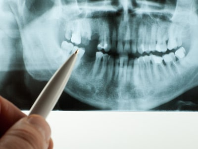 Can a Root Canal Cause Health Issues?