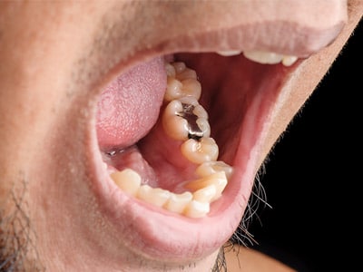 Amalgam Toxicity: Are You Breathing Silver Fillings?