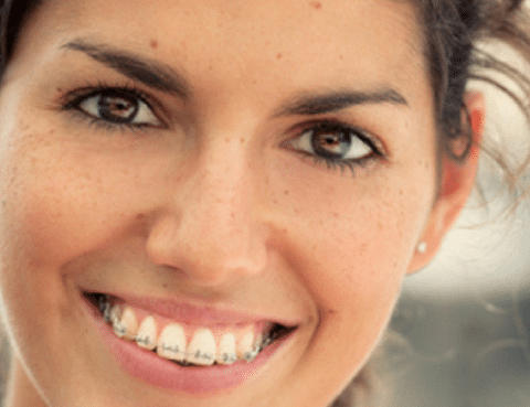 adults wearing braces