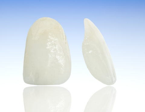 Why Does My Tooth Need a Crown?